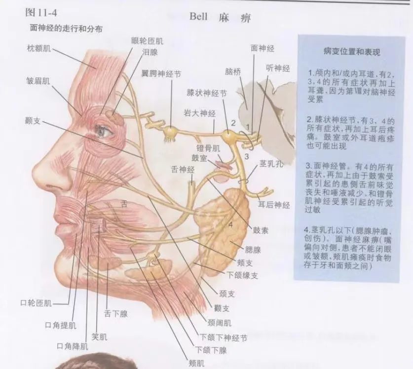 面神经解剖和麻痹示意图,来源:奈特神经系统疾病图谱比如面神经管前的