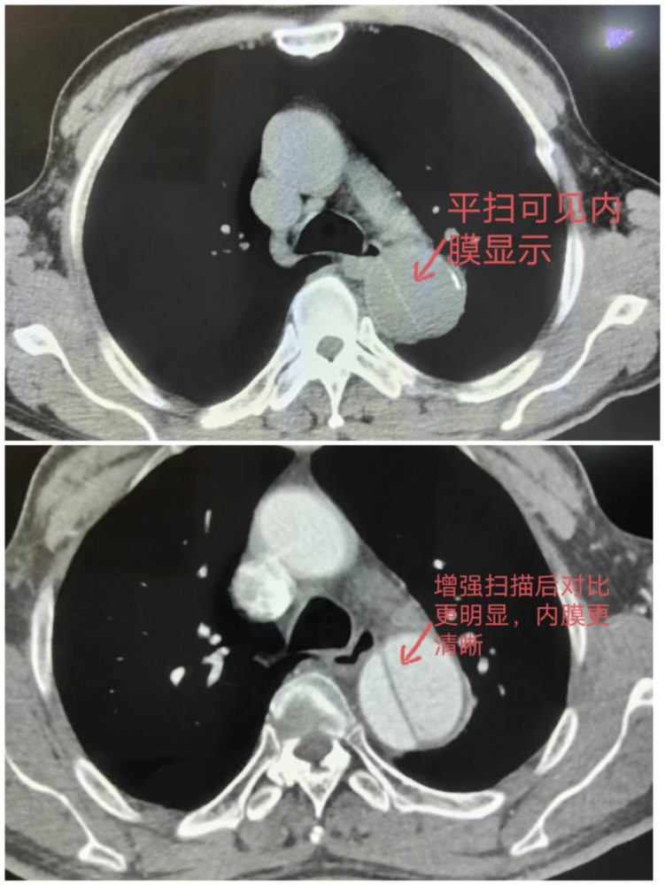 急危重症影像科紧急为疑似主动脉夹层病人行主动脉cta检查