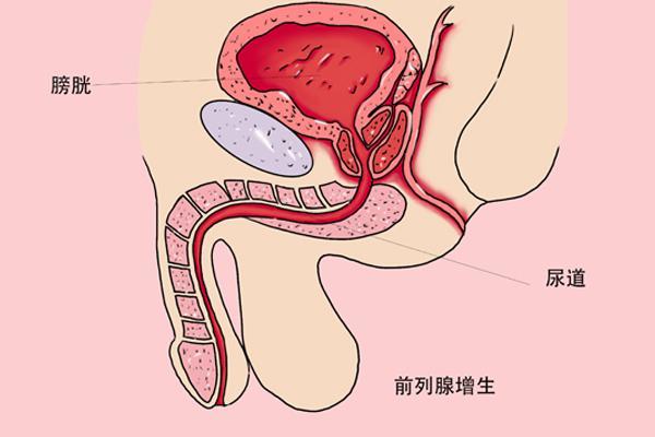 前列腺不好3个坏习惯要改掉腺体越来越健康