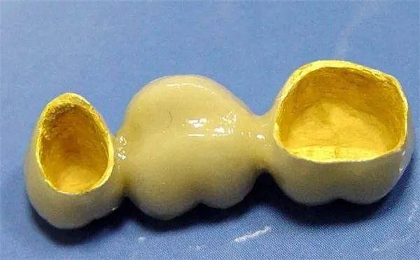 牙冠的种类及价格了解了就会选_腾讯新闻