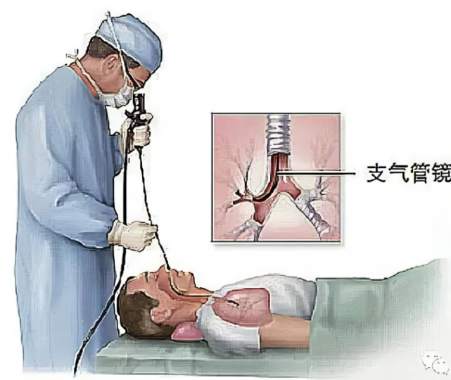 原来气管镜是这样做的