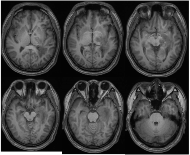 病例展示中枢神经系统脱髓鞘疾病是一组脑和脊髓以髓鞘破坏或髓鞘脱失