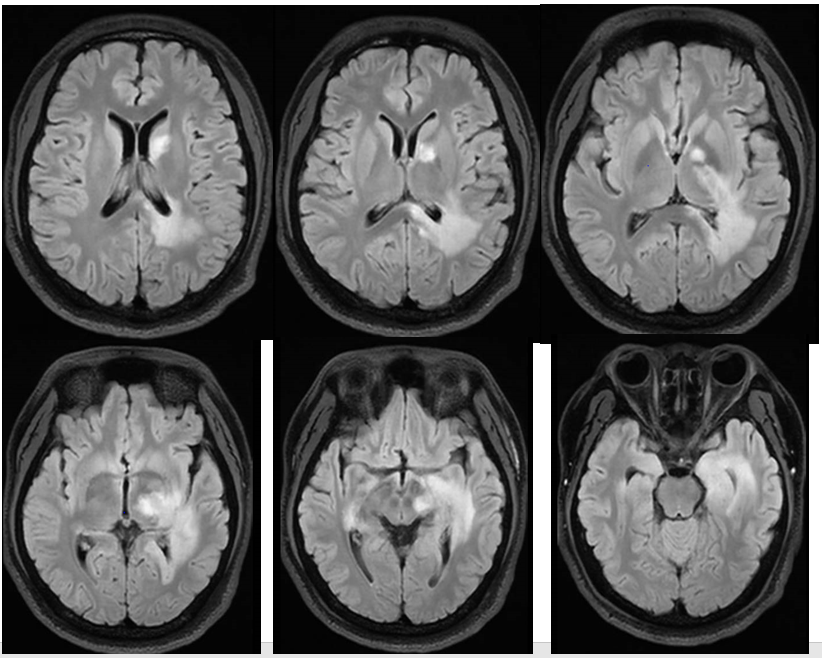 病例展示中枢神经系统脱髓鞘疾病是一组脑和脊髓以髓鞘破坏或髓鞘脱失