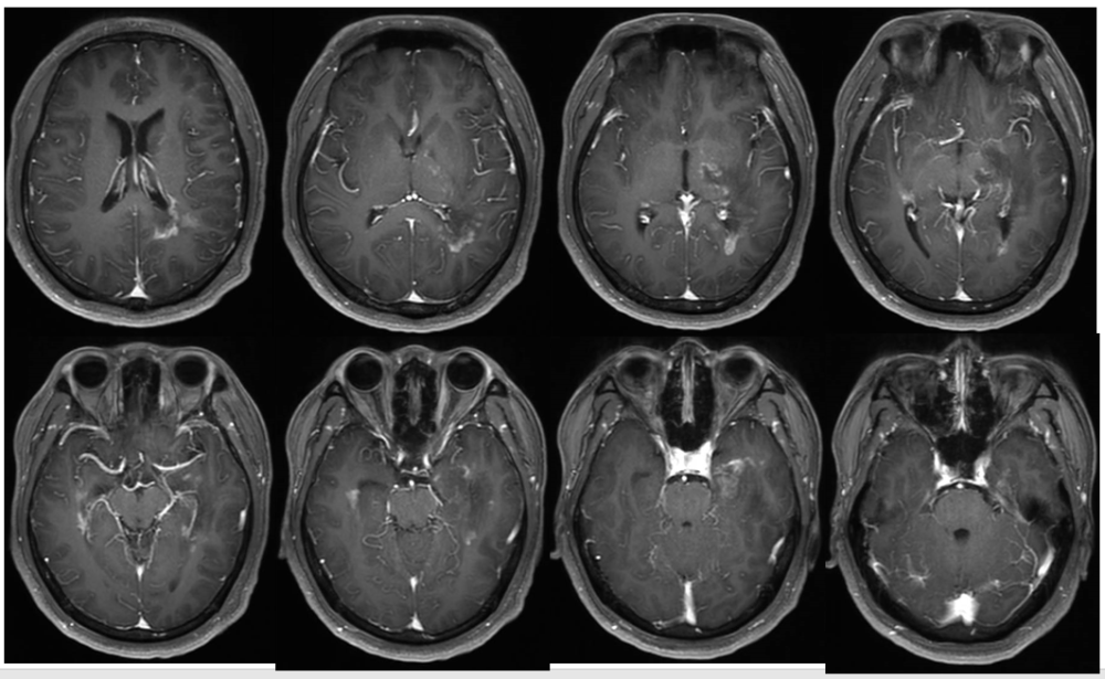 病例展示中枢神经系统脱髓鞘疾病是一