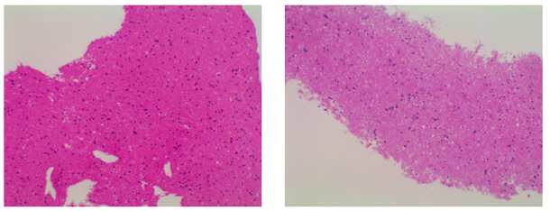 脱髓鞘病变的影像表现你了解多少