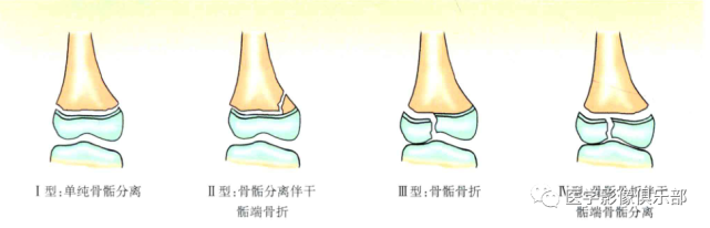 Ⅳ型:骨骺骨折伴干骺端骨骺分离.