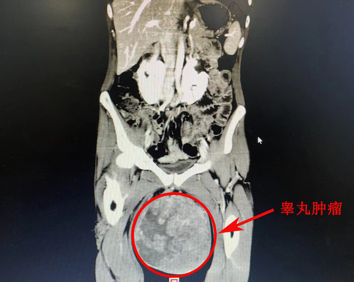 阴囊肉瘤图片图片