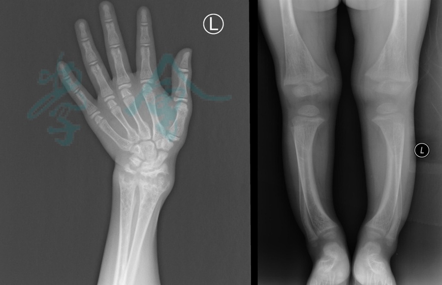 【内分泌罕见病】最新诊断流程图,《中国低血磷性佝偻病/骨软化症诊疗