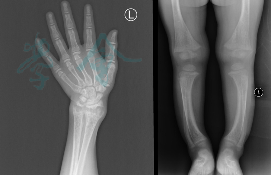 注:x线表现有干骺端增宽,生长板增厚,长骨骺端模糊,呈毛刷征图1 xlh