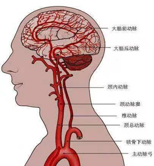 科普高级卒中中心科普系列第二十三期丨脑血管造影术