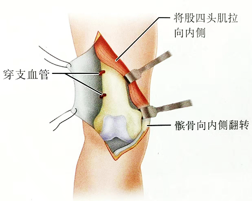 一文掌握|胫骨前,后外侧手术入路技巧详解