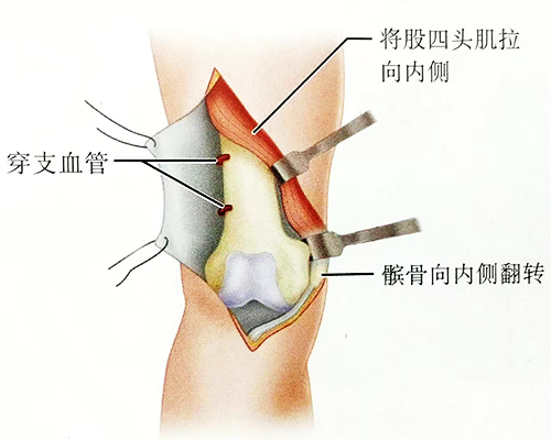 股骨髁間骨折的入路和固定技巧