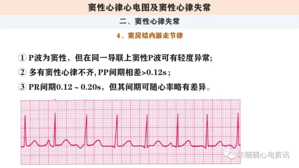 心電圖解讀第三講:竇性心律心電圖及竇性心律失常(ppt)_騰訊新聞