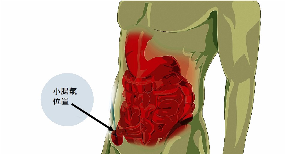 不容忽视小肠气严重或致肠梗塞