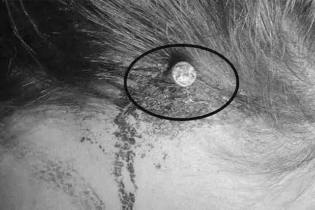 这名孕妇声称自己的头骨里插了一根两英寸长的钉子