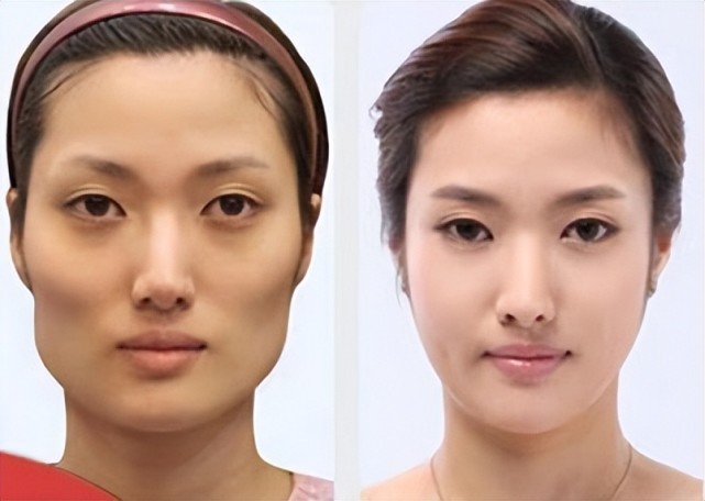 方脸磨骨有什么后遗症,削骨一年后的忠告,拿走不谢