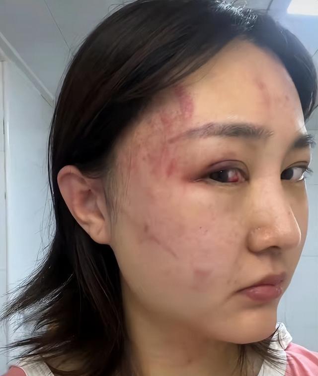 网红徐大宝称被丈夫家暴脸上多处淤青伤痕明显男方却称其炒作