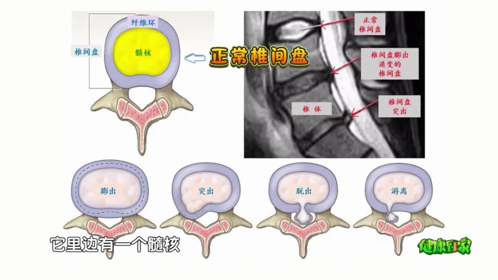 一個動作就能測出腰好不好每天正確鍛鍊遠離腰間盤突出