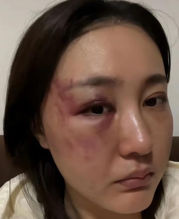 演员徐大宝痛诉遭老公家暴,眼睛里满是红血丝,曾被打到痛哭插图2