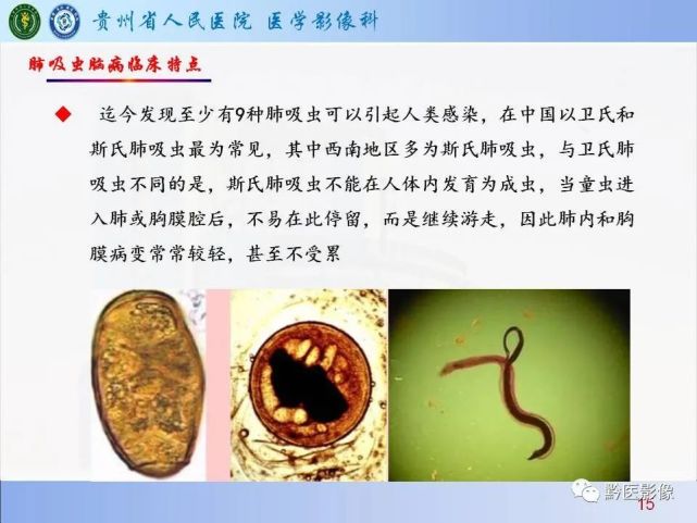 肺吸虫脑病影像与临床