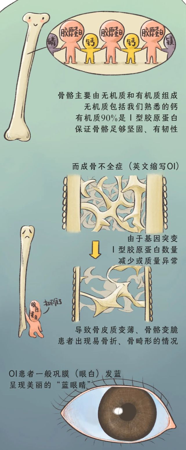 与 wishbone day成骨不全症(osteogenesis imperfecta,oi)又名脆骨病