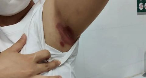 间擦疹也叫擦烂红斑,擦烂.