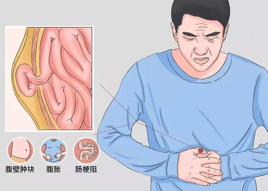 疝氣突發莫慌張牢記這幾個急救措施