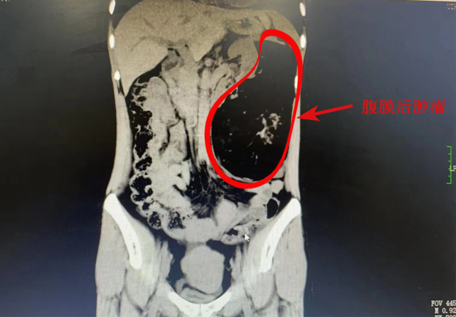 長沙39歲的周女士半年前就摸到自己左上腹部有一個硬塊,以為是腸脹氣