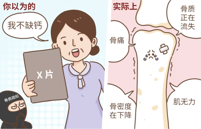 骨量的丢失不够多时没啥征兆,x 线片也「正常」,或者仅仅骨头痛,肌肉
