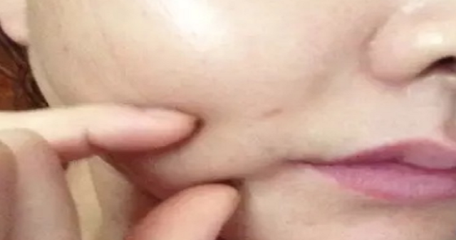 【郑州美莱】面中部凹陷,不同的解决方法也不同-cw资讯网