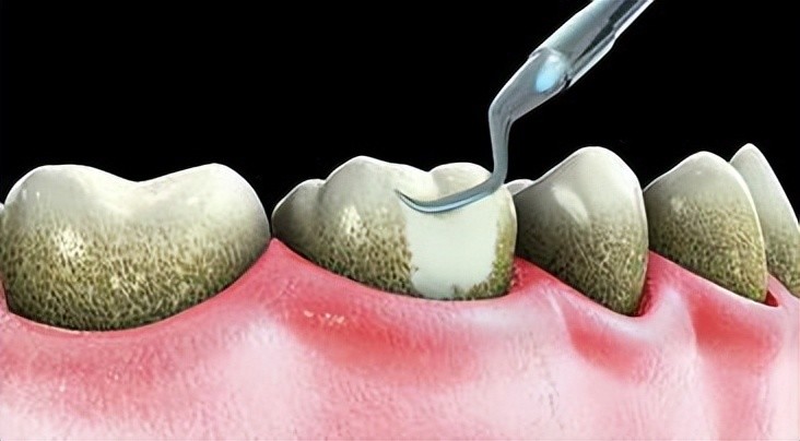 為啥會長牙結石可以直接用手摳掉嗎牙科醫生揭曉答案