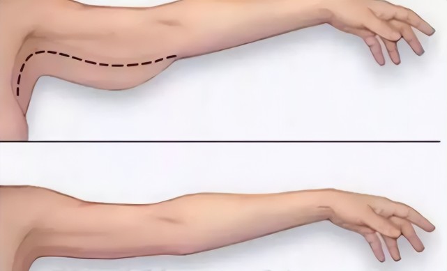 其次因為年齡的增長,皮膚鬆弛,手臂脂肪自然下垂.