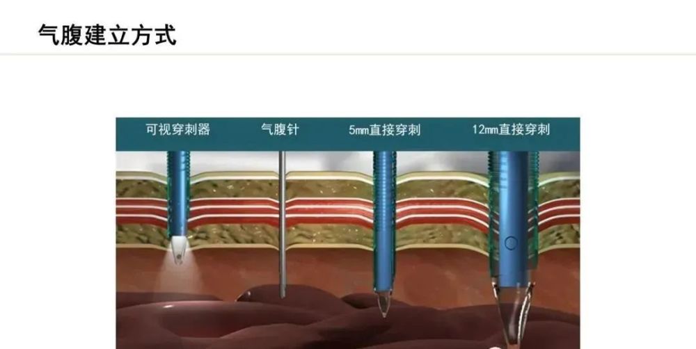 腹腔镜穿刺通道置入技巧及防范_腾讯新闻