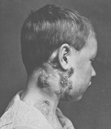 老鼠疮人们不惜挖开国王的坟墓只为用那骷髅手触碰肿胀的脖子