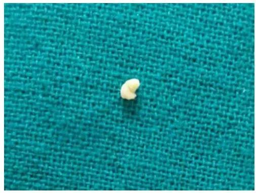 去了医院耳鼻喉科,医生看到他包起来的"小石头",有的部分已经碎成了