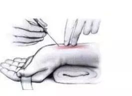 一针见血教你几招搞定桡动脉穿刺技术