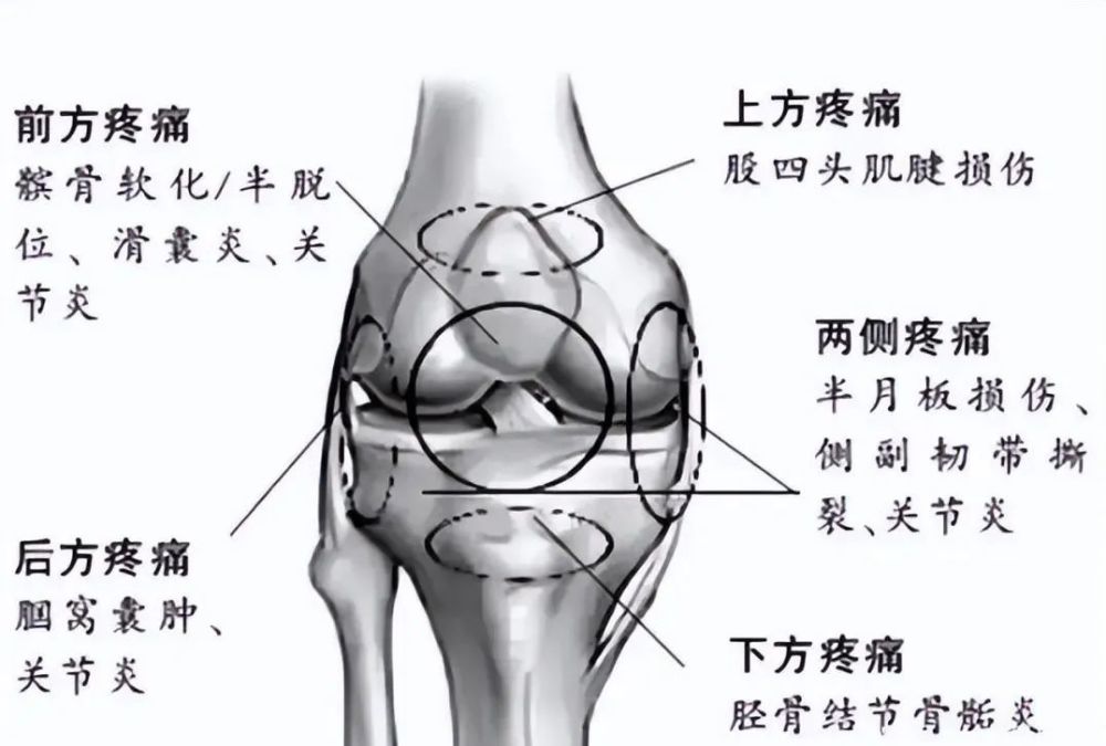 應力性脛骨骨折過量跑步後發生疲勞性脛骨骨膜炎卻不加重視是極其容易