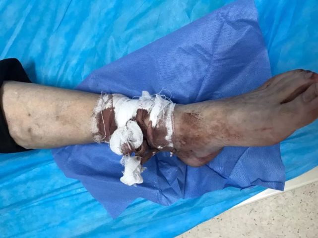 静脉曲张|下肢静脉曲张破裂出血怎么办?