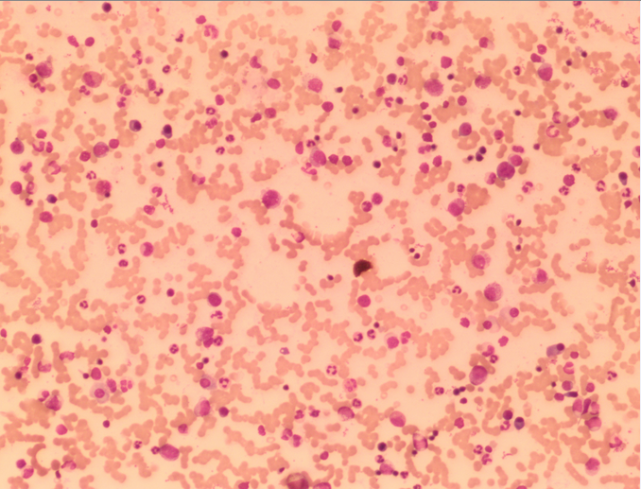 认真浏览两张骨髓片后,终于找到比较典型的吞噬细胞吞噬血细胞现象.