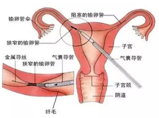 之前很多女性為了避孕,會在生完孩子之後去做輸卵管結紮手術.