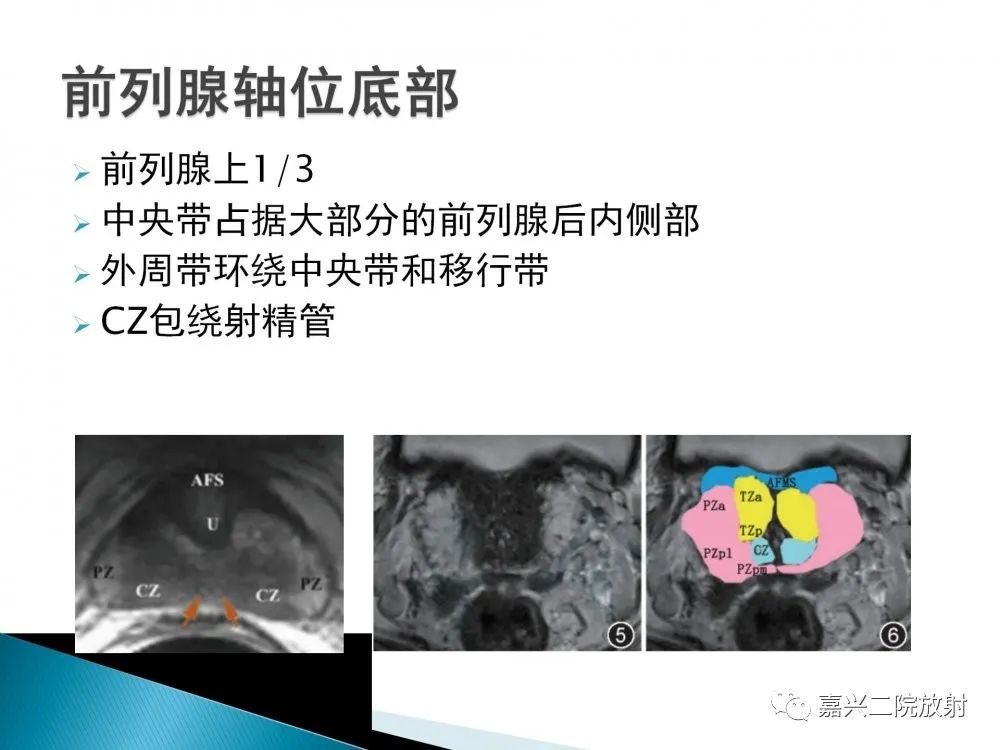 前列腺解剖分區及pi-rads v2.1版解讀_騰訊新聞