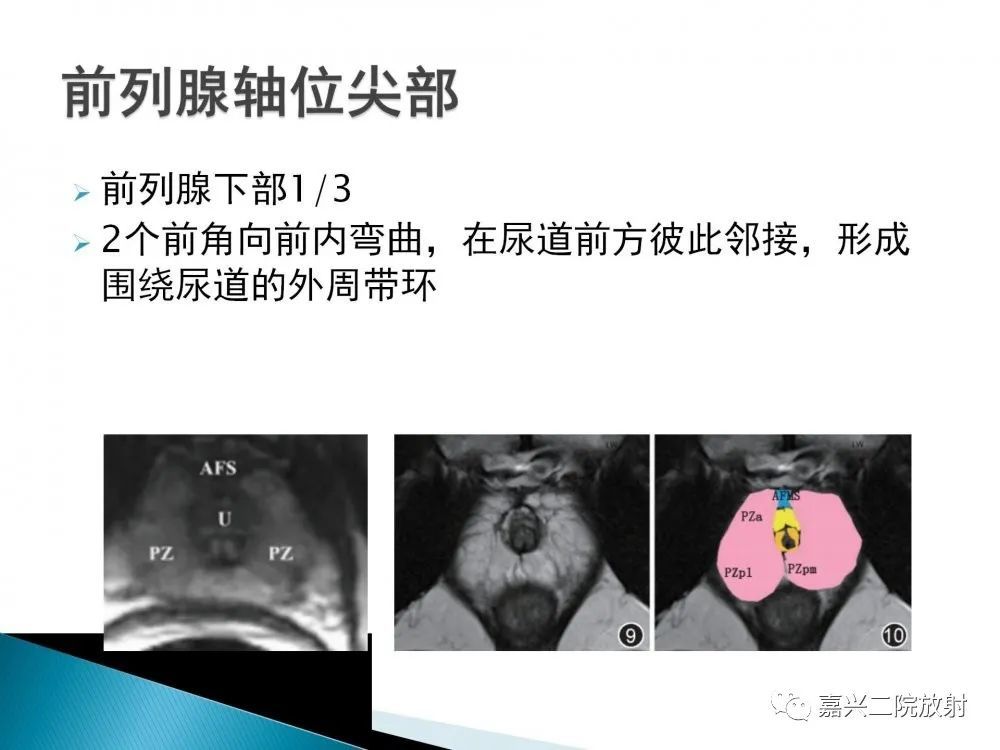 前列腺解剖分區及pi-rads v2.1版解讀_騰訊新聞