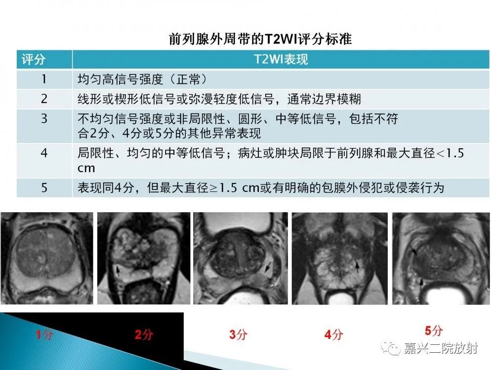 前列腺解剖分區及pi-rads v2.1版解讀_騰訊新聞