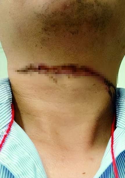 男子骑车时脖子被勒,连人带车摔倒