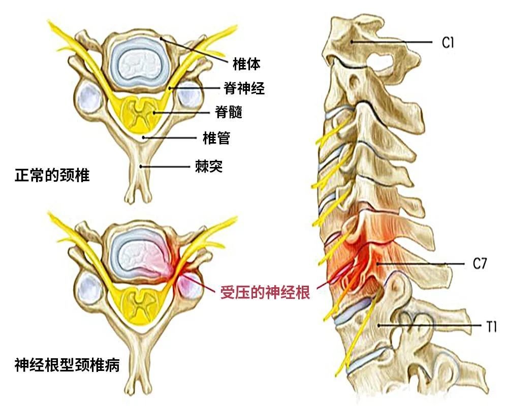 頸椎椎間盤或椎間關節等結構有退變,老化.2.