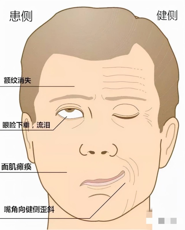 严重面瘫图片图片