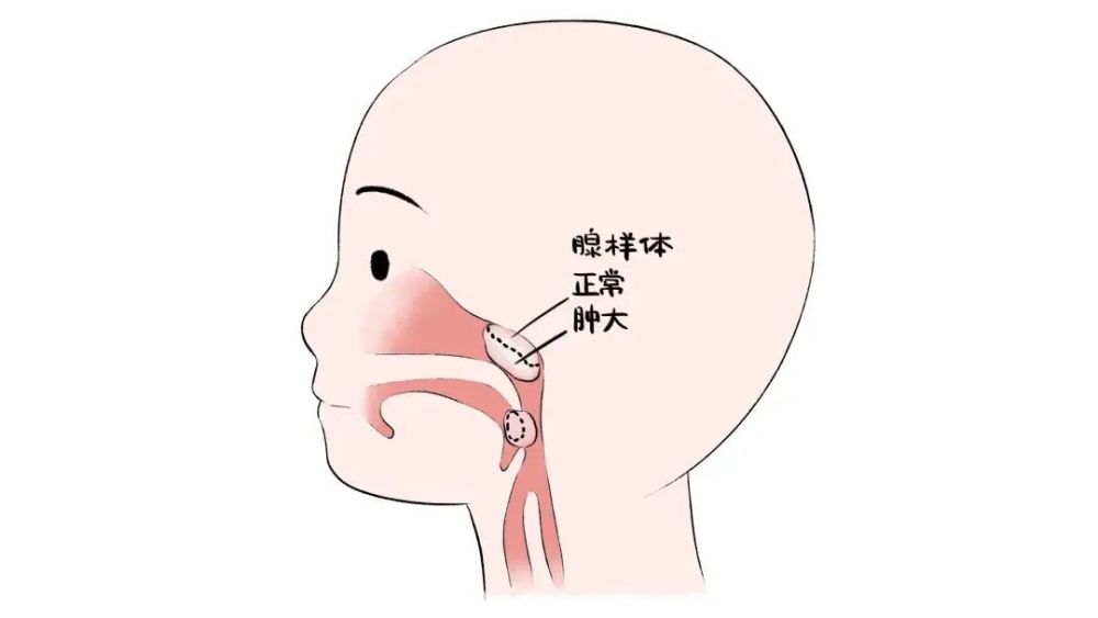 帶大寶去兒童醫院的耳鼻喉科檢查,拍過片子之後,醫生確診大寶是腺樣體