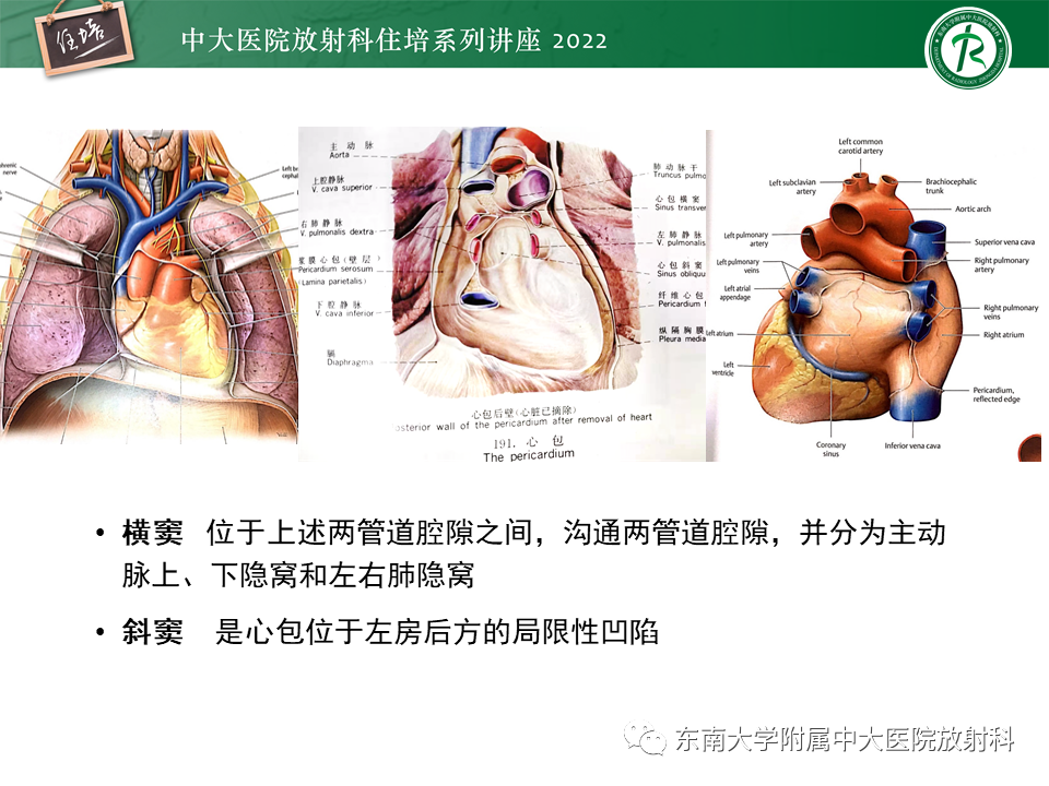 心包隐窝的ct解剖