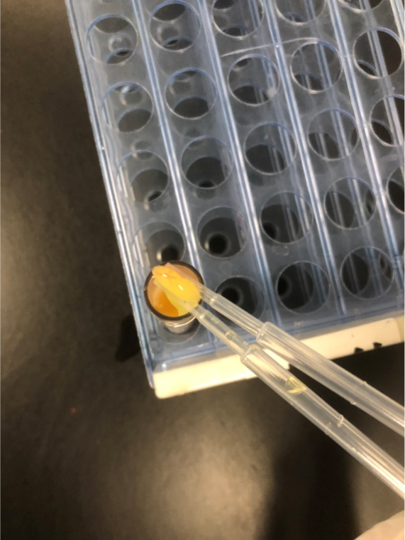 一例临床少见的胶冻状血清案例分析