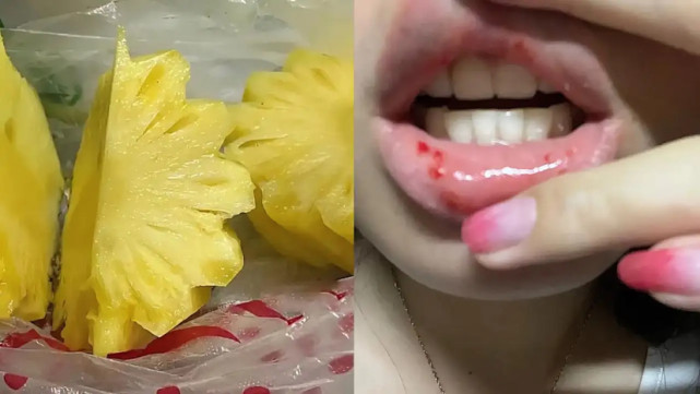 女生吃了半个菠萝嘴巴出血肿胀,菠萝你知道该怎么吃吗?